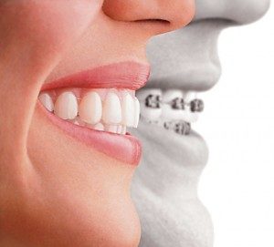 Invisalign criteria