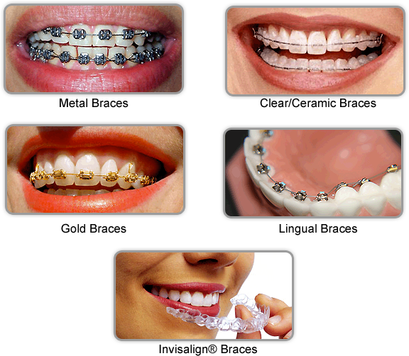 Braces: Types & How They Work