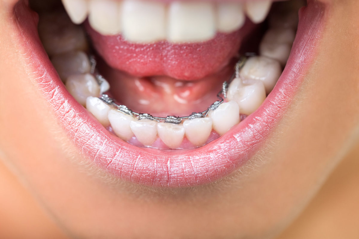 The Different Types of Braces: Which One Is Right for You?