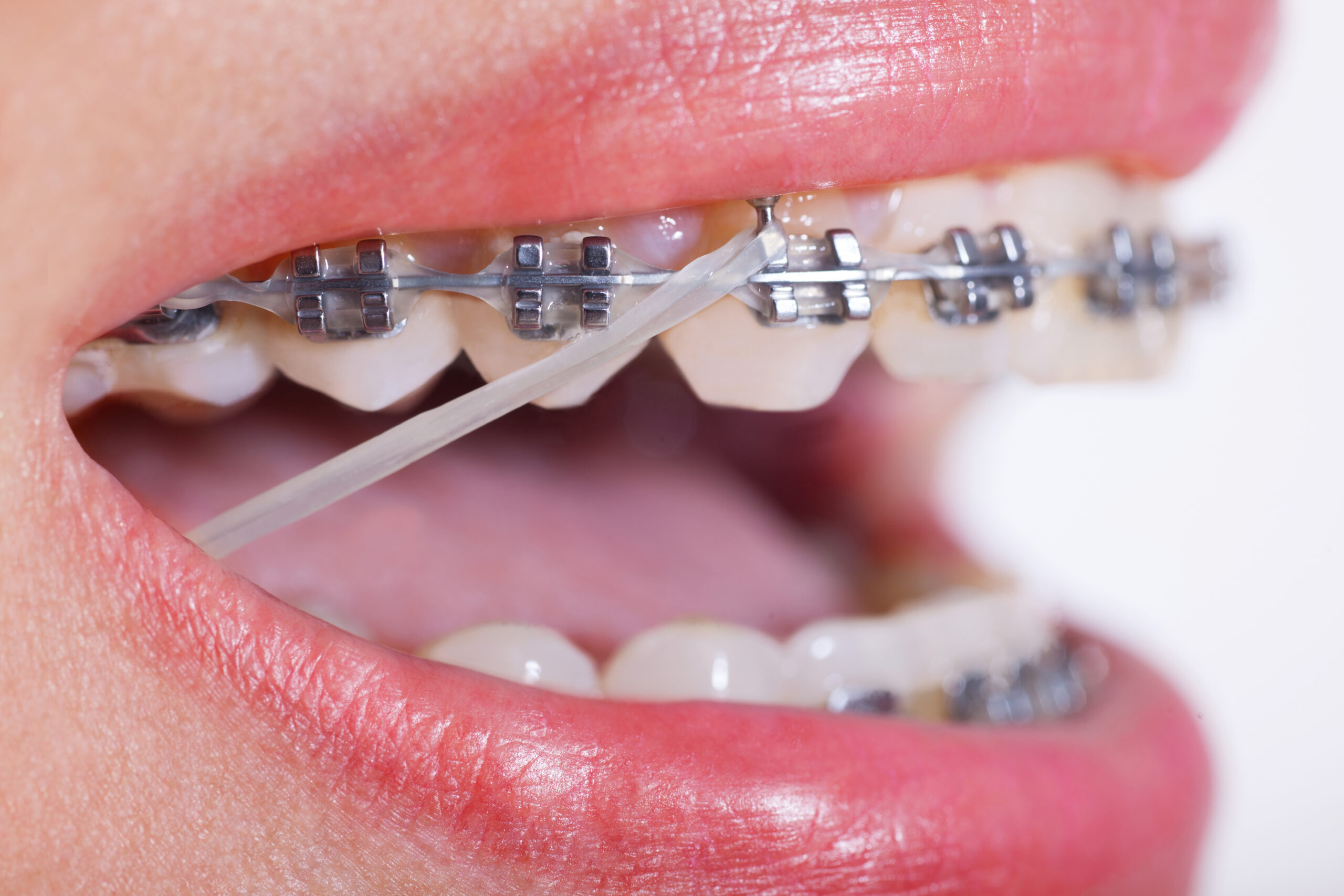 Rubber Bands 101 for Braces 