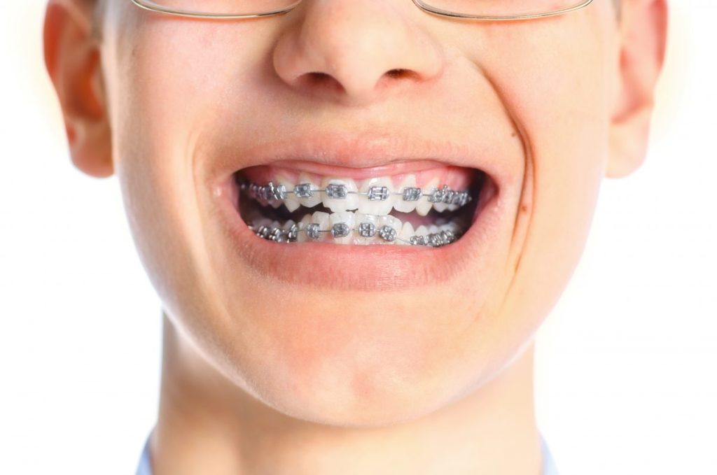 A young man with braces on his teeth.