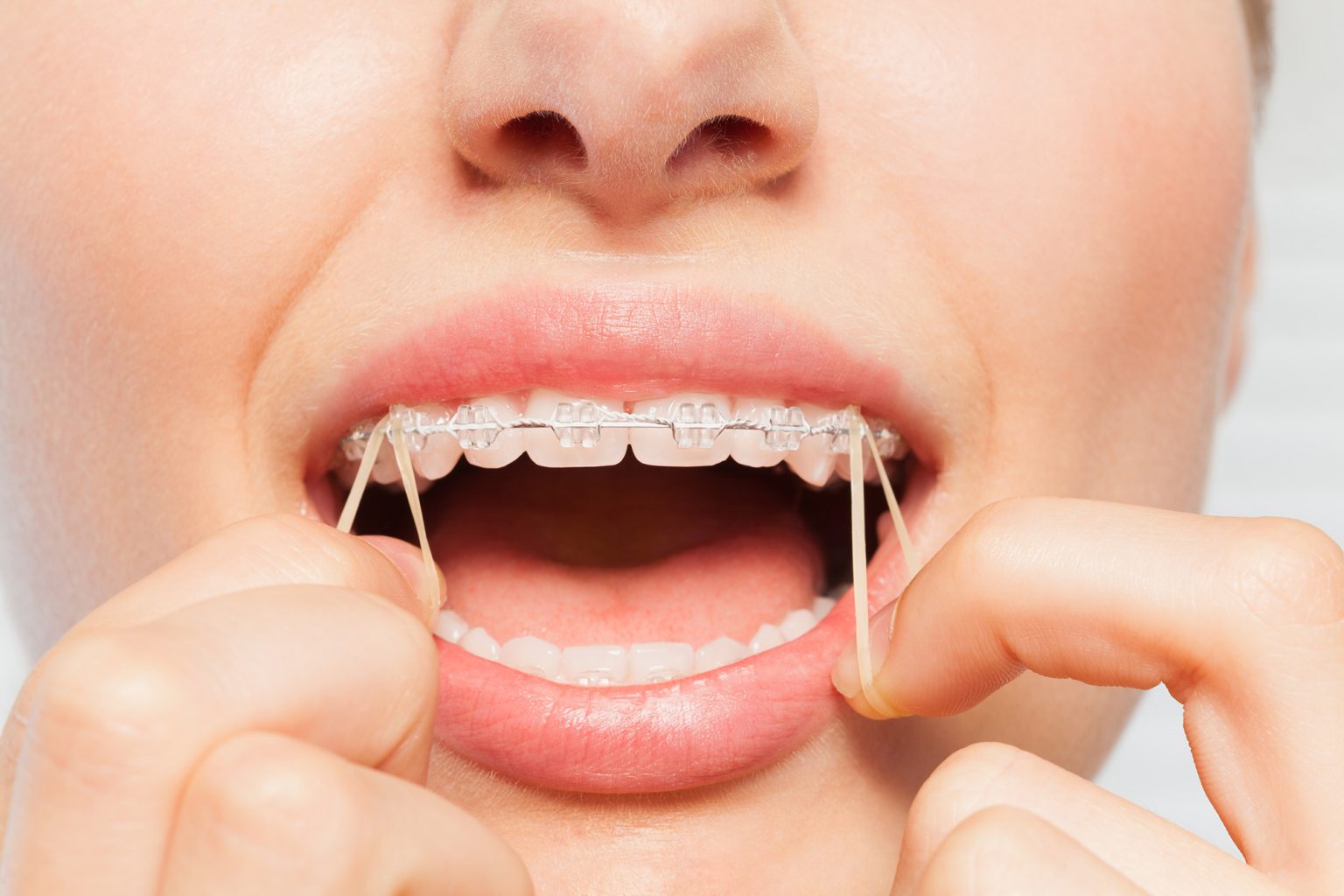 Rubber Bands For Braces 1536x1024 