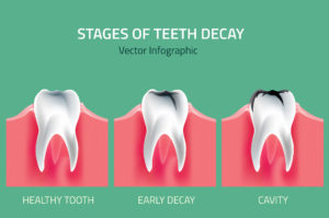 tooth decay